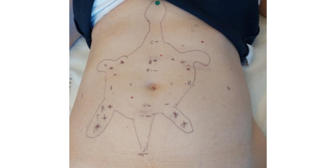 Abdominale Akupunktur Abdominale Akupunktur